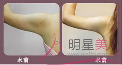 手臂抽脂后可以用力嗎