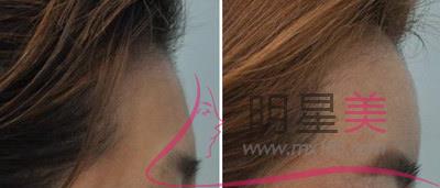 整<a href=http://www.sbs17.com/listinfo-629-0.html target=_blank class=infotextkey>下頜角</a>和顴骨