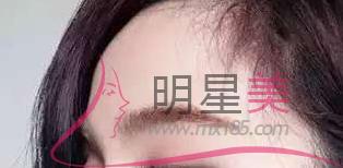 填充<a href=http://www.sbs17.com/listinfo-722-0.html target=_blank class=infotextkey>臥蠶</a>可以用<a href=http://www.sbs17.com/listinfo-731-0.html target=_blank class=infotextkey>玻尿酸</a>嗎
