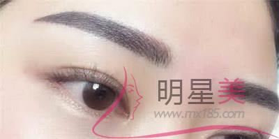 提眉手術(shù)記錄