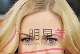 <a href=http://www.sbs17.com/listinfo-690-0.html target=_blank class=infotextkey>自體脂肪填充</a>額頭腫脹期多久