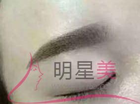 紋眉屬于手術(shù)嗎