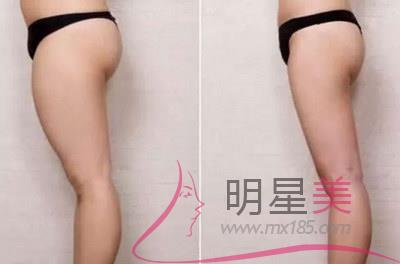 抽腿部脂肪幾天可以上班