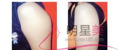 手臂<a href=http://www.sbs17.com/listinfo-685-0.html target=_blank class=infotextkey>吸脂</a>對身體有危害嗎