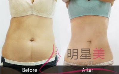 腰腹<a href=http://www.sbs17.com/listinfo-685-0.html target=_blank class=infotextkey>吸脂</a>恢復(fù)期特別癢脫皮