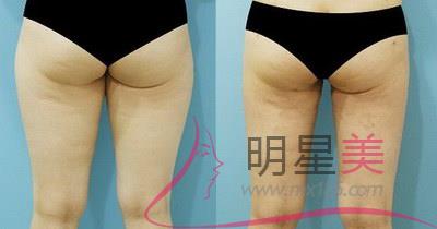 腿部<a href=http://www.sbs17.com/listinfo-685-0.html target=_blank class=infotextkey>吸脂</a>后會變漂亮嗎