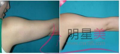 手臂<a href=http://www.sbs17.com/listinfo-685-0.html target=_blank class=infotextkey>吸脂</a>600毫升多嗎