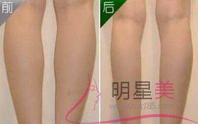腿部<a href=http://www.sbs17.com/listinfo-685-0.html target=_blank class=infotextkey>吸脂</a>后的腫脹期：如何正確應(yīng)對
