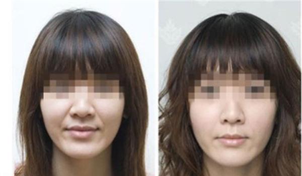 做<a href=http://www.sbs17.com/listinfo-792-0.html target=_blank class=infotextkey>去法令紋</a>不適應(yīng)人群有哪些