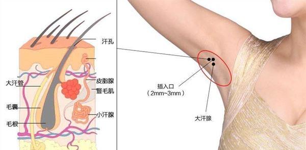 做冷凍法<a href=http://www.sbs17.com/listinfo-766-0.html target=_blank class=infotextkey>去腋臭</a>風(fēng)險(xiǎn)有哪些