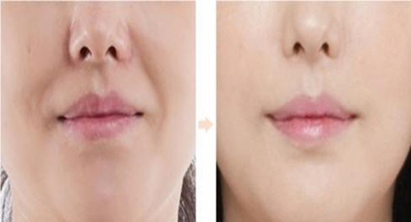 做懸吊<a href=http://www.sbs17.com/listinfo-614-0.html target=_blank class=infotextkey>除皺</a><a href=http://www.sbs17.com/listinfo-792-0.html target=_blank class=infotextkey>去法令紋</a>手術(shù)時(shí)間是多久？