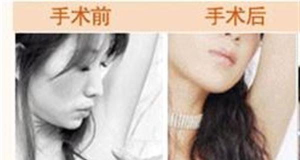 電離子<a href=http://www.sbs17.com/listinfo-784-0.html target=_blank class=infotextkey>去狐臭</a>手術(shù)效果好不好？