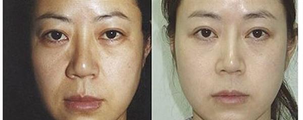 做激光祛曬斑的流程是什么？恢復(fù)時間要多久？