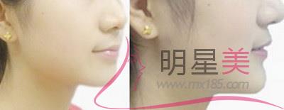 抽脂<a href=http://www.sbs17.com/listinfo-630-0.html target=_blank class=infotextkey>豐太陽穴</a>多久才能側(cè)著睡