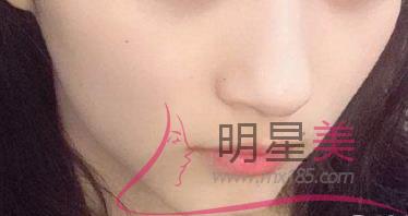 抽脂<a href=http://www.sbs17.com/listinfo-630-0.html target=_blank class=infotextkey>豐太陽穴</a>的副作用