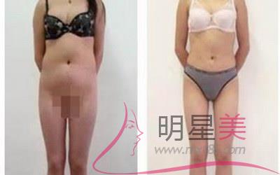 常熟去哪兒<a href=http://www.sbs17.com/listinfo-682-0.html target=_blank class=infotextkey>溶脂</a>好