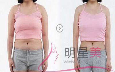 抽脂有沒風險