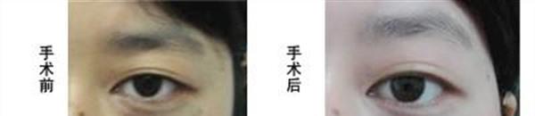 冷凍去除太田痣手術(shù)的方法是什么？