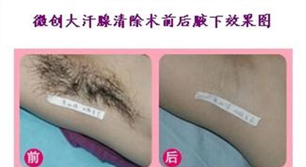 電離子<a href=http://www.sbs17.com/listinfo-766-0.html target=_blank class=infotextkey>去腋臭</a>手術(shù)的方法是什么？
