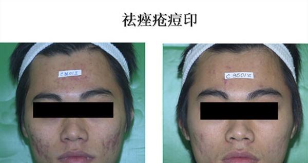 紅藍(lán)光祛痘麻醉方式是什么？