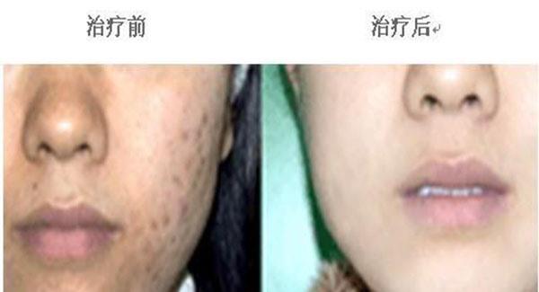 做冷凍治療<a href=http://www.sbs17.com/listinfo-797-0.html target=_blank class=infotextkey>去痘疤</a>副作用