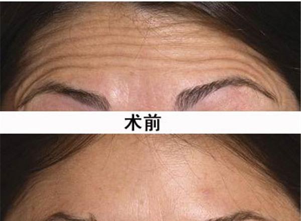 做<a href=http://www.sbs17.com/listinfo-734-0.html target=_blank class=infotextkey>愛貝芙</a>去除抬頭紋價格