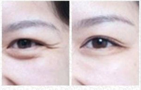 <a href=http://www.sbs17.com/listinfo-734-0.html target=_blank class=infotextkey>愛貝芙</a><a href=http://www.sbs17.com/listinfo-780-0.html target=_blank class=infotextkey>去魚尾紋</a>不適用人群有哪些？