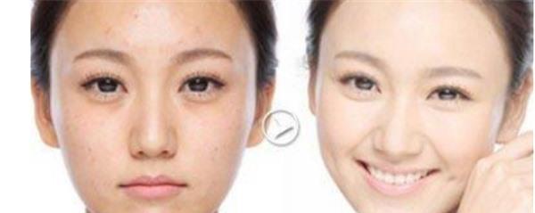 做E光美白價(jià)格大概需要多少