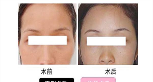 自體脂肪<a href=http://www.sbs17.com/listinfo-797-0.html target=_blank class=infotextkey>去痘疤</a>麻醉方式是什么？