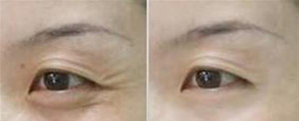 激光除魚尾紋維持時間是多久？
