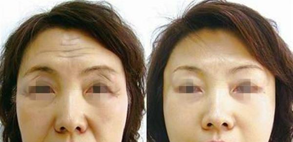 激光去除抬頭紋需要怎么護理？