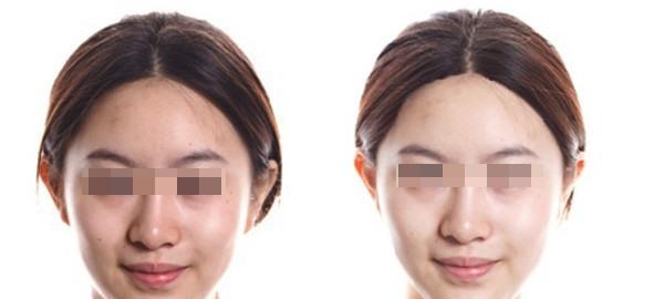 RV極速美塑美膚適合什么人？