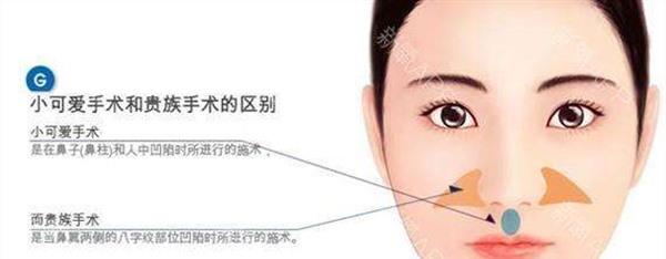 自體脂肪<a href=http://www.sbs17.com/listinfo-792-0.html target=_blank class=infotextkey>去法令紋</a>手術(shù)安全嗎？