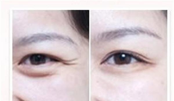 自體脂肪<a href=http://www.sbs17.com/listinfo-780-0.html target=_blank class=infotextkey>去魚尾紋</a>要多少錢？