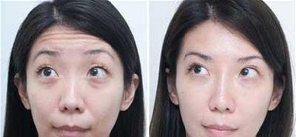 做光子除抬頭紋多少錢