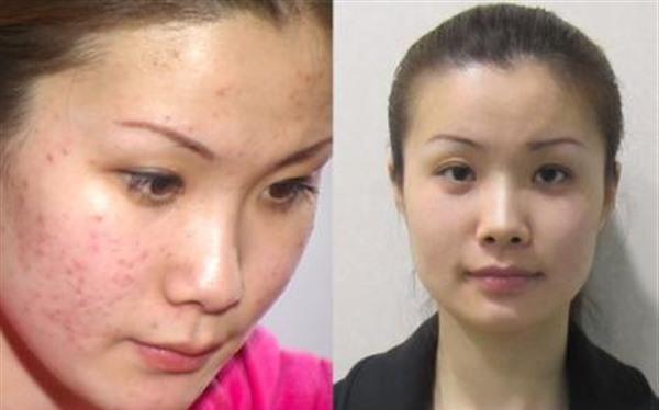 做E光去痘印多少錢