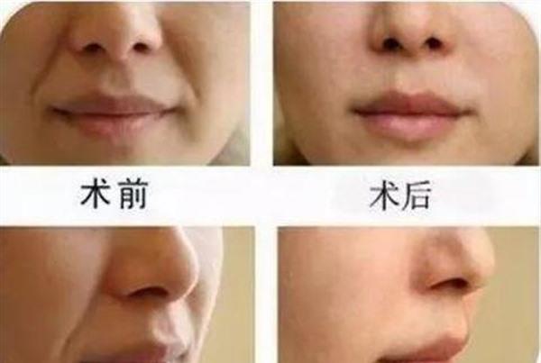 做懸吊<a href=http://www.sbs17.com/listinfo-614-0.html target=_blank class=infotextkey>除皺</a><a href=http://www.sbs17.com/listinfo-792-0.html target=_blank class=infotextkey>去法令紋</a>手術(shù)多少錢？