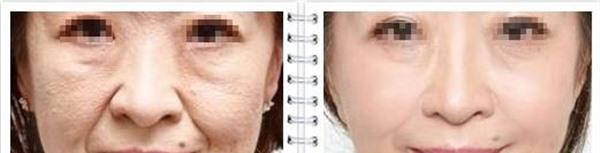 內(nèi)窺鏡<a href=http://www.sbs17.com/listinfo-614-0.html target=_blank class=infotextkey>除皺</a><a href=http://www.sbs17.com/listinfo-780-0.html target=_blank class=infotextkey>去魚尾紋</a>手術(shù)效果好不好？