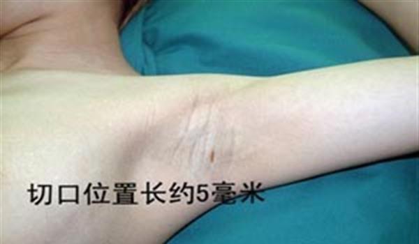 電離子<a href=http://www.sbs17.com/listinfo-784-0.html target=_blank class=infotextkey>去狐臭</a>手術(shù)術(shù)后護(hù)理？