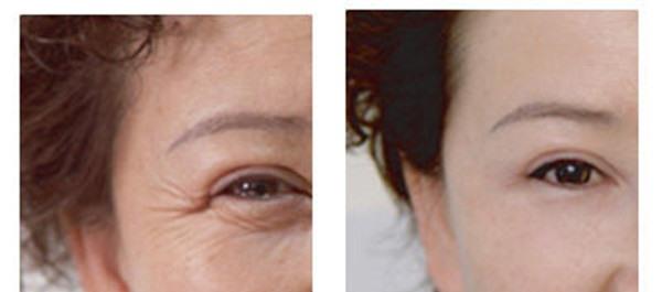 果酸換膚<a href=http://www.sbs17.com/listinfo-782-0.html target=_blank class=infotextkey>去眼角細紋</a>多少錢？