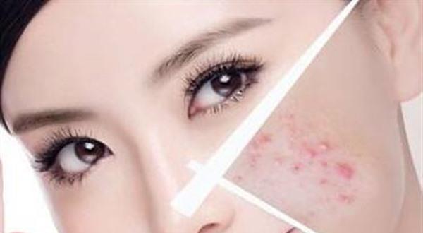做<a href=http://www.sbs17.com/listinfo-613-0.html target=_blank class=infotextkey>射頻</a><a href=http://www.sbs17.com/listinfo-768-0.html target=_blank class=infotextkey>微針</a><a href=http://www.sbs17.com/listinfo-797-0.html target=_blank class=infotextkey>去痘疤</a>費用要多少