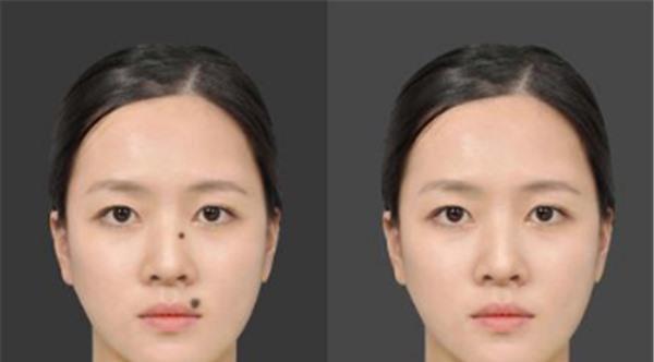 做點(diǎn)痣不適應(yīng)人群有哪些