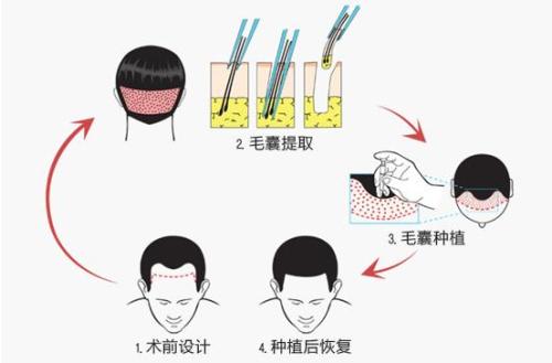 自體<a href=http://www.sbs17.com/listinfo-664-0.html target=_blank class=infotextkey>毛發(fā)種植</a>多少錢 自體<a href=http://www.sbs17.com/listinfo-664-0.html target=_blank class=infotextkey>毛發(fā)種植</a>哪一步最關(guān)鍵