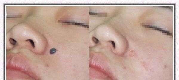 E光點(diǎn)痣適應(yīng)癥狀是什么？