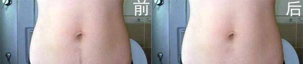 剖腹產(chǎn)疤痕修復(fù)要多少錢？