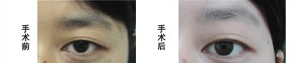 剝脫治療太田痣麻醉方式是什么？