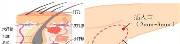電離子<a href=http://www.sbs17.com/listinfo-766-0.html target=_blank class=infotextkey>去腋臭</a>麻醉方式是什么？