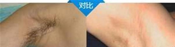 做冷凍<a href=http://www.sbs17.com/listinfo-784-0.html target=_blank class=infotextkey>去狐臭</a>多少錢