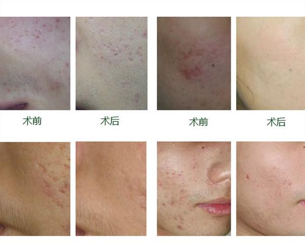 做自體脂肪<a href=http://www.sbs17.com/listinfo-797-0.html target=_blank class=infotextkey>去痘疤</a>效果好不好
