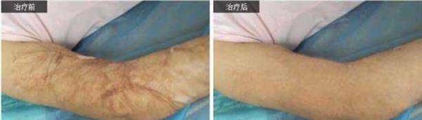 做燙傷疤痕修復(fù)價(jià)格要多少